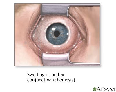 chmsusis|Chemosis: MedlinePlus Medical Encyclopedia.